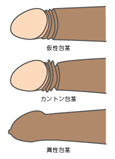 包茎は治さないとイケないのか？